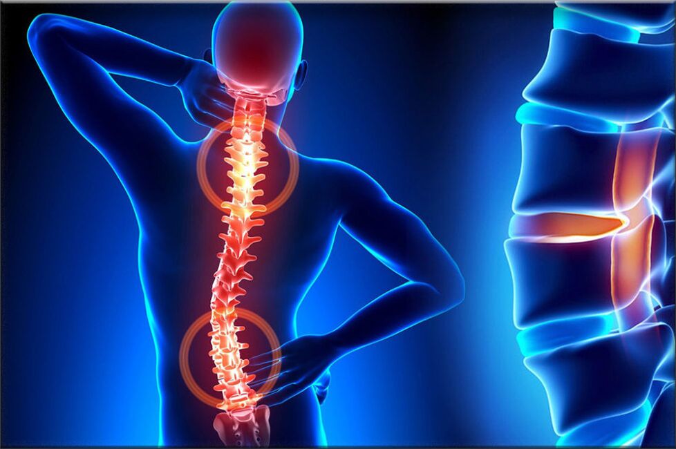 artroza vratne hrbtenice