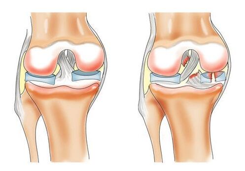 zdravo koleno in artroza kolenskega sklepa