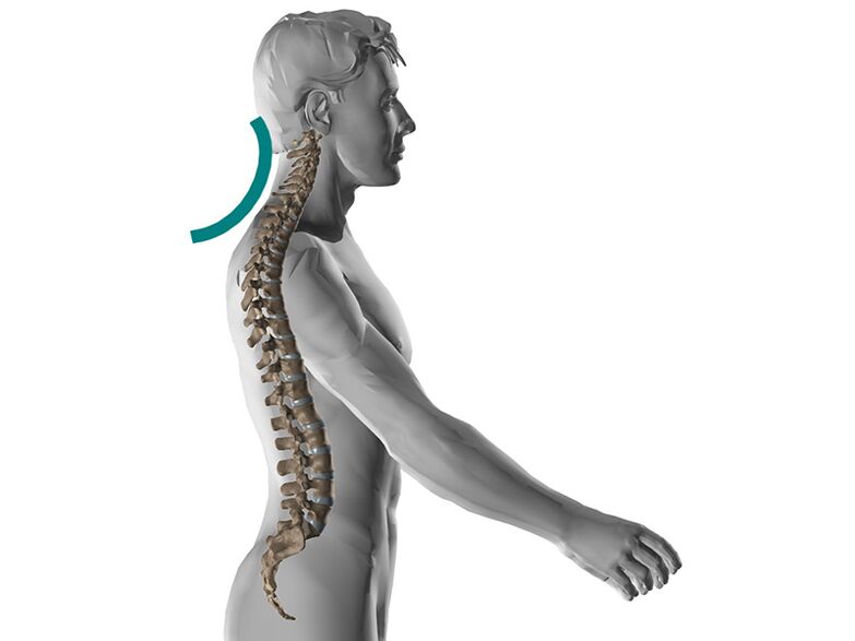 Cervikalna osteohondroza hrbtenice, ki povzroča številne neprijetne simptome